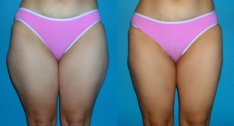 Abdominal High-Definition Liposuction Before & After Gallery - Patient 486696 - Image 1
