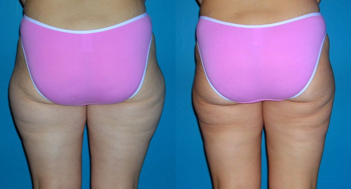 Abdominal High-Definition Liposuction Before & After Gallery - Patient 486696 - Image 2