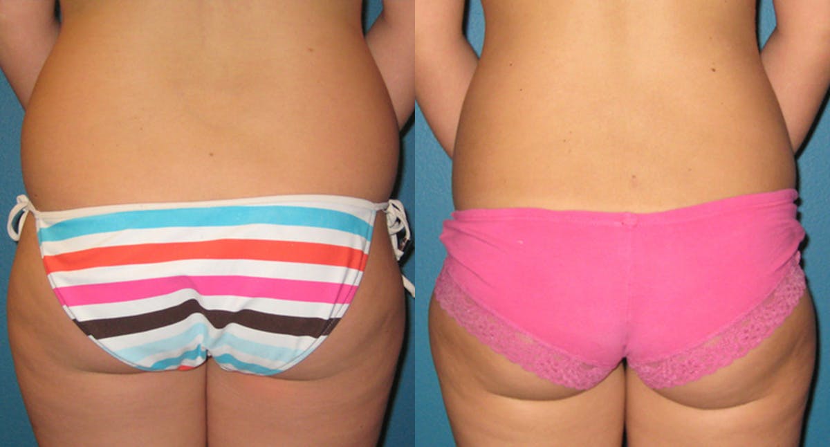 Abdominal High-Definition Liposuction Before & After Gallery - Patient 104679 - Image 2