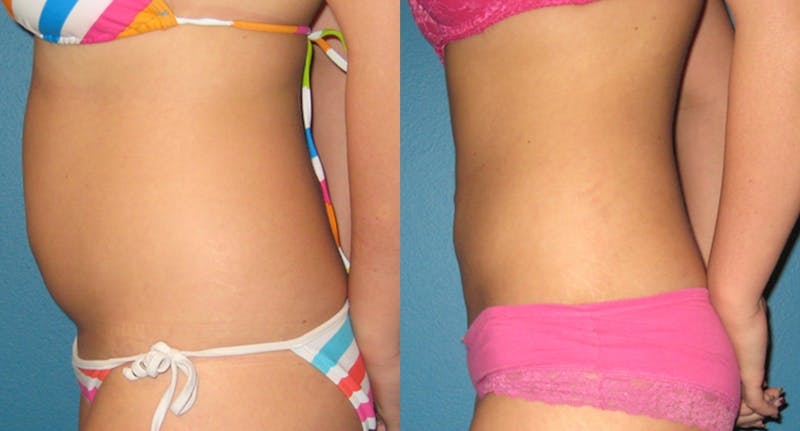 Abdominal High-Definition Liposuction Before & After Gallery - Patient 104679 - Image 1