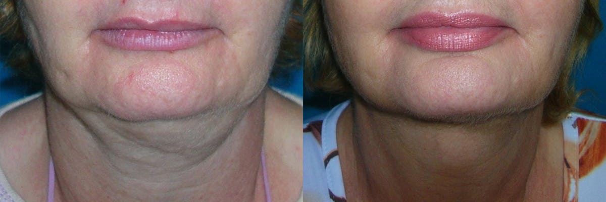 Face & Neck Liposuction Before & After Gallery - Patient 230256 - Image 1