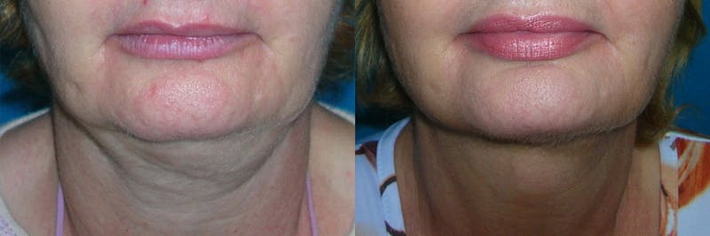 Face & Neck Liposuction Before & After Gallery - Patient 230256 - Image 1