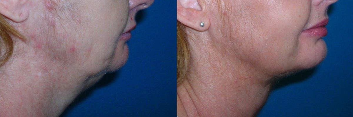 Face & Neck Liposuction Before & After Gallery - Patient 230256 - Image 2