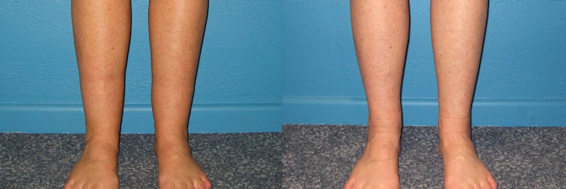 Leg & Ankle Liposuction Before & After Gallery - Patient 282615 - Image 1