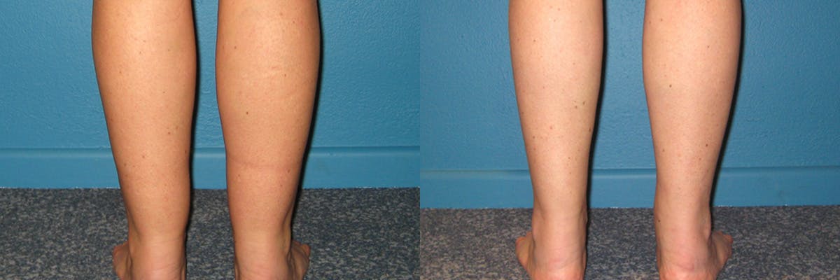Leg & Ankle Liposuction Before & After Gallery - Patient 282615 - Image 2