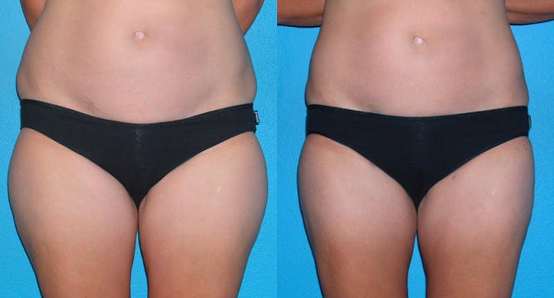 Abdominal High-Definition Liposuction Before & After Gallery - Patient 224835 - Image 1
