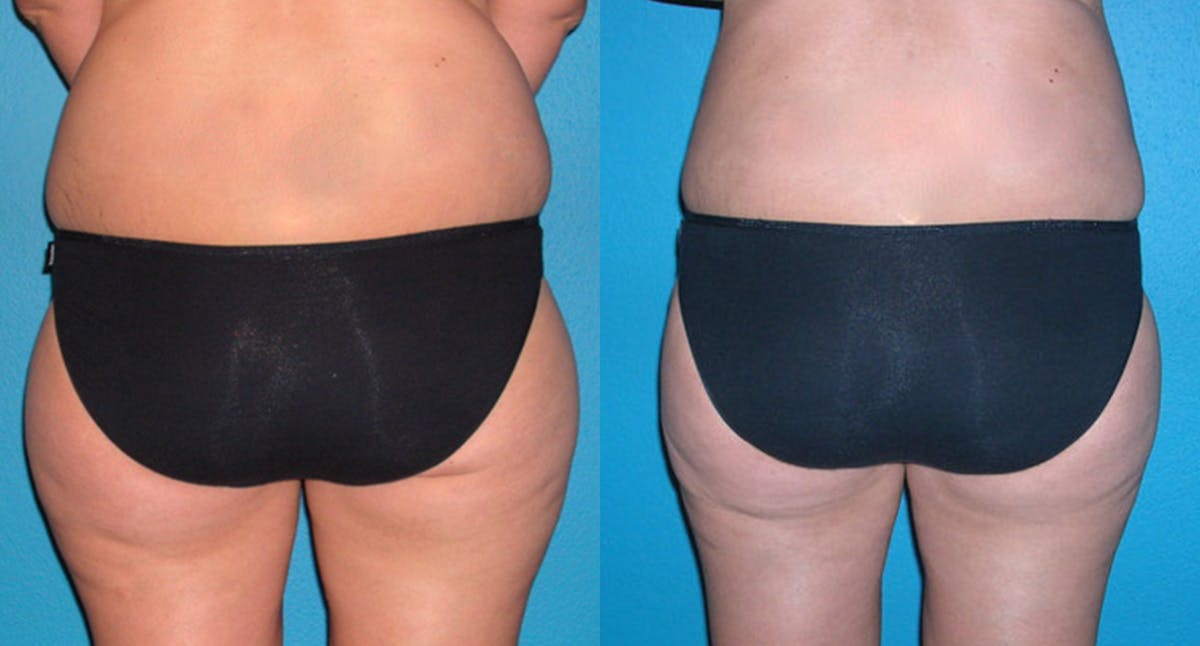 Abdominal High-Definition Liposuction Before & After Gallery - Patient 224835 - Image 2