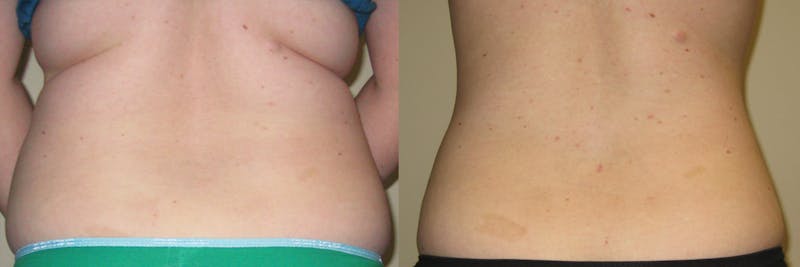 Abdominal High-Definition Liposuction Before & After Gallery - Patient 390272 - Image 1
