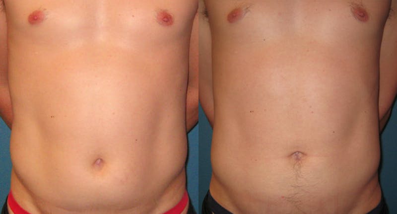 Abdominal High-Definition Liposuction Before & After Gallery - Patient 284876 - Image 1
