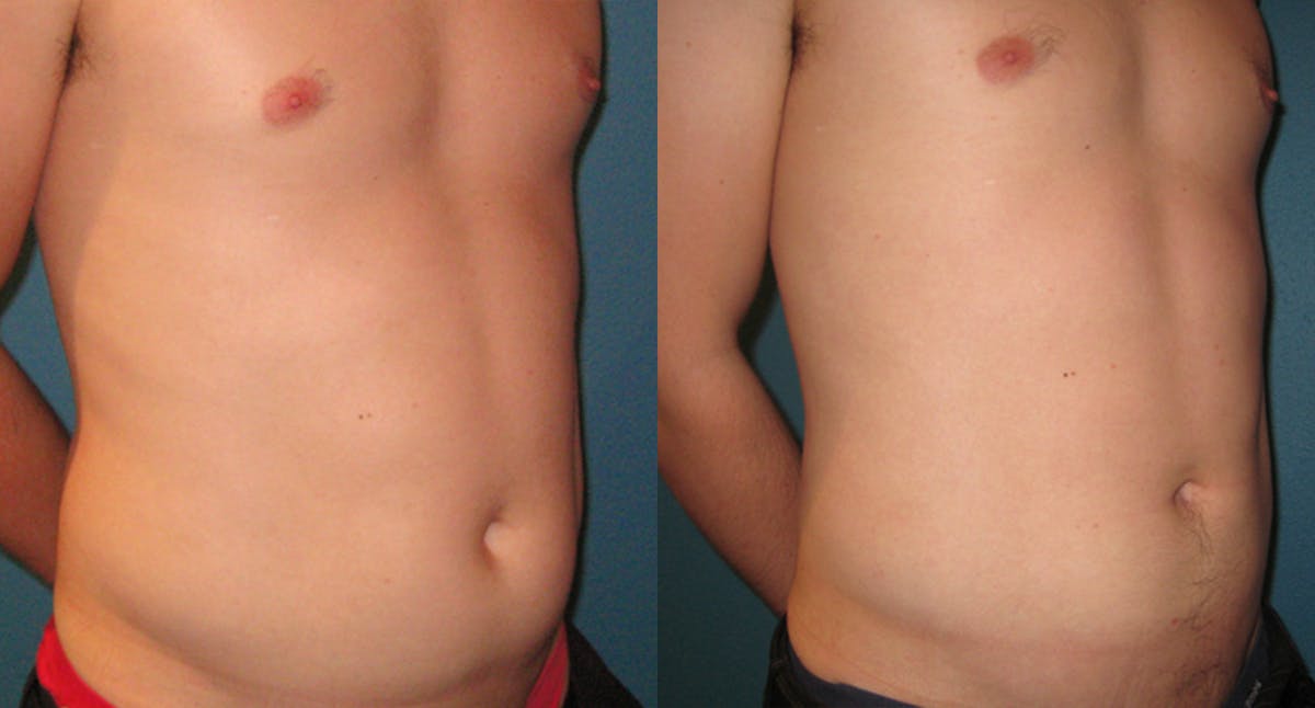 Abdominal High-Definition Liposuction Before & After Gallery - Patient 284876 - Image 2