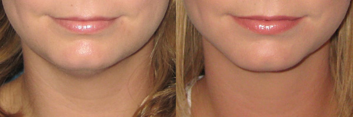 Face & Neck Liposuction Before & After Gallery - Patient 247124 - Image 1