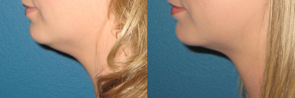 Face & Neck Liposuction Before & After Gallery - Patient 247124 - Image 2