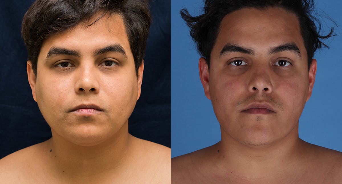 Face & Neck Liposuction Before & After Gallery - Patient 572511 - Image 1