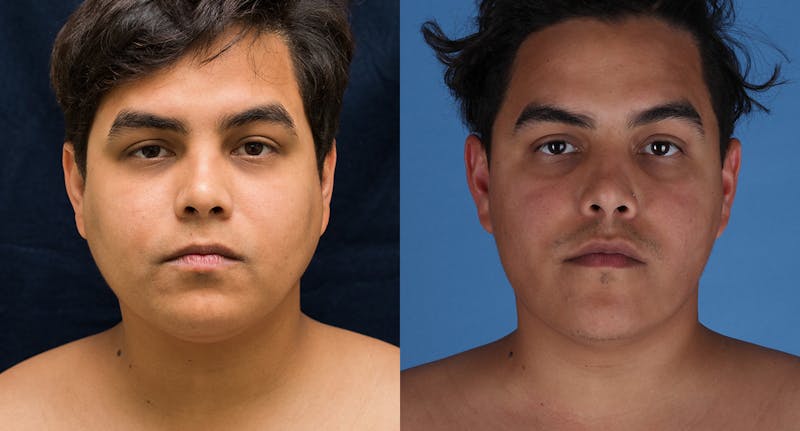 Face & Neck Liposuction Before & After Gallery - Patient 572511 - Image 1