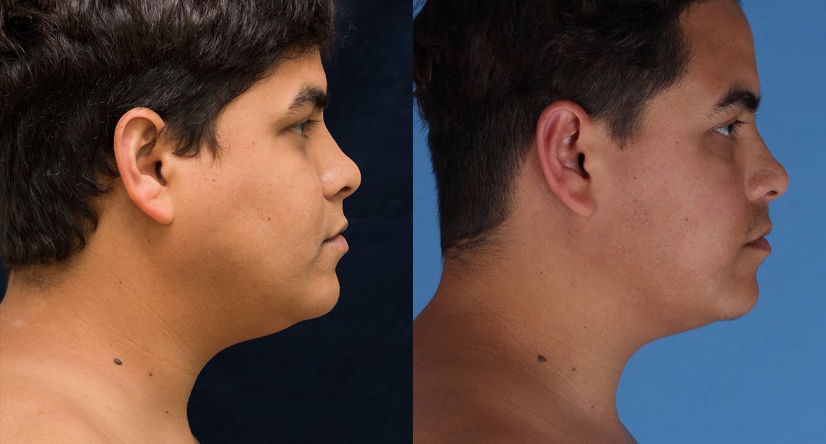Face & Neck Liposuction Before & After Gallery - Patient 572511 - Image 3