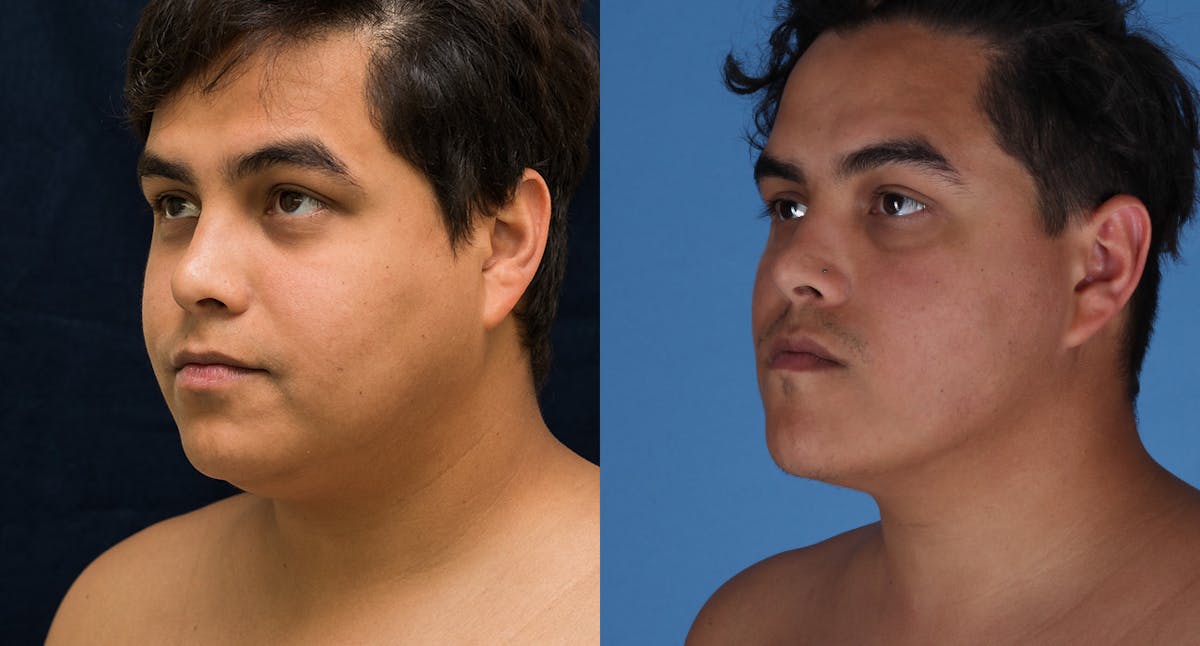Face & Neck Liposuction Before & After Gallery - Patient 572511 - Image 2