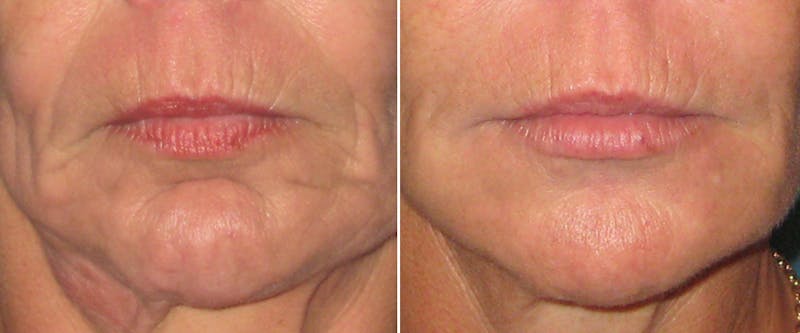 Facial Fillers Before & After Gallery - Patient 351164 - Image 1