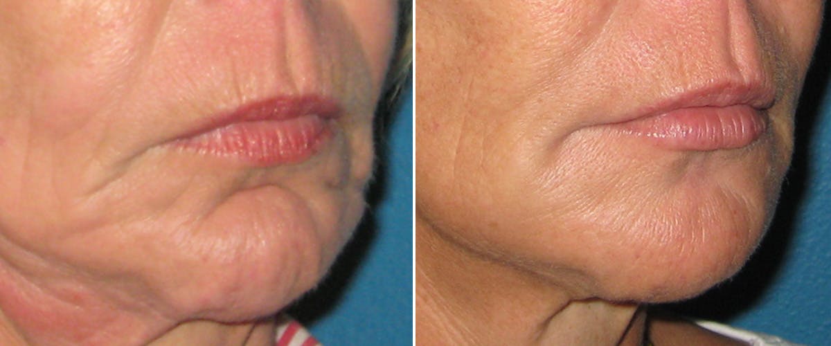 Facial Fillers Before & After Gallery - Patient 351164 - Image 2