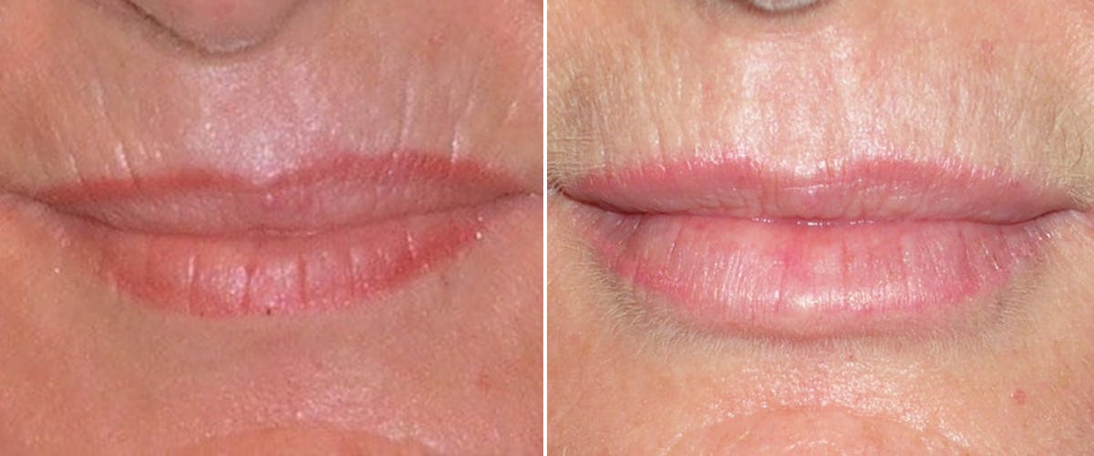 Facial Fillers Before & After Gallery - Patient 230994 - Image 1