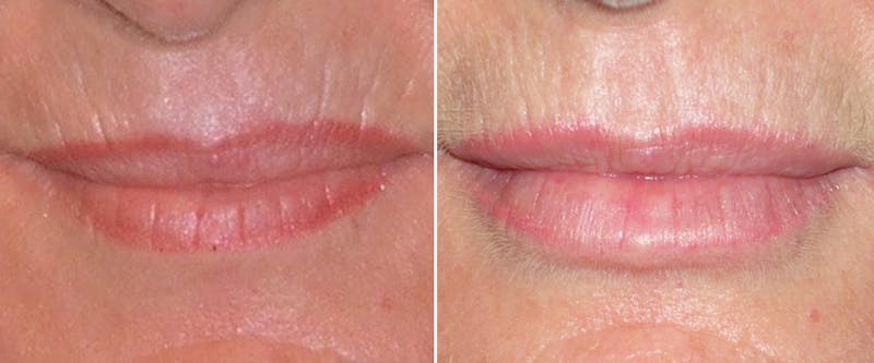 Facial Fillers Before & After Gallery - Patient 230994 - Image 1