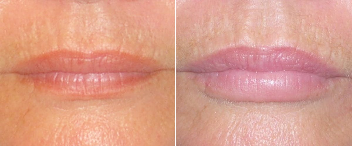 Facial Fillers Before & After Gallery - Patient 265150 - Image 1