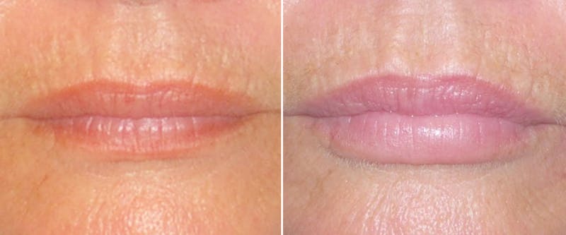 Facial Fillers Before & After Gallery - Patient 265150 - Image 1