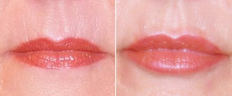 Facial Fillers Before & After Gallery - Patient 361590 - Image 1