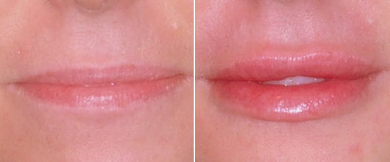 Facial Fillers Before & After Gallery - Patient 254878 - Image 1