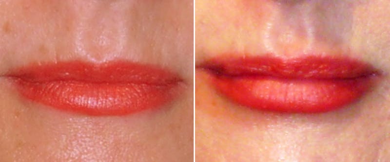Facial Fillers Before & After Gallery - Patient 275247 - Image 1