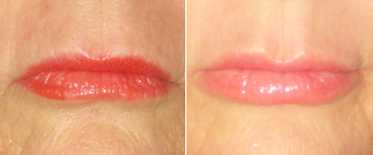 Facial Fillers Before & After Gallery - Patient 349143 - Image 1