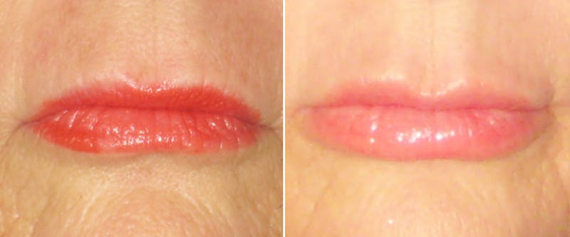 Facial Fillers Before & After Gallery - Patient 349143 - Image 1