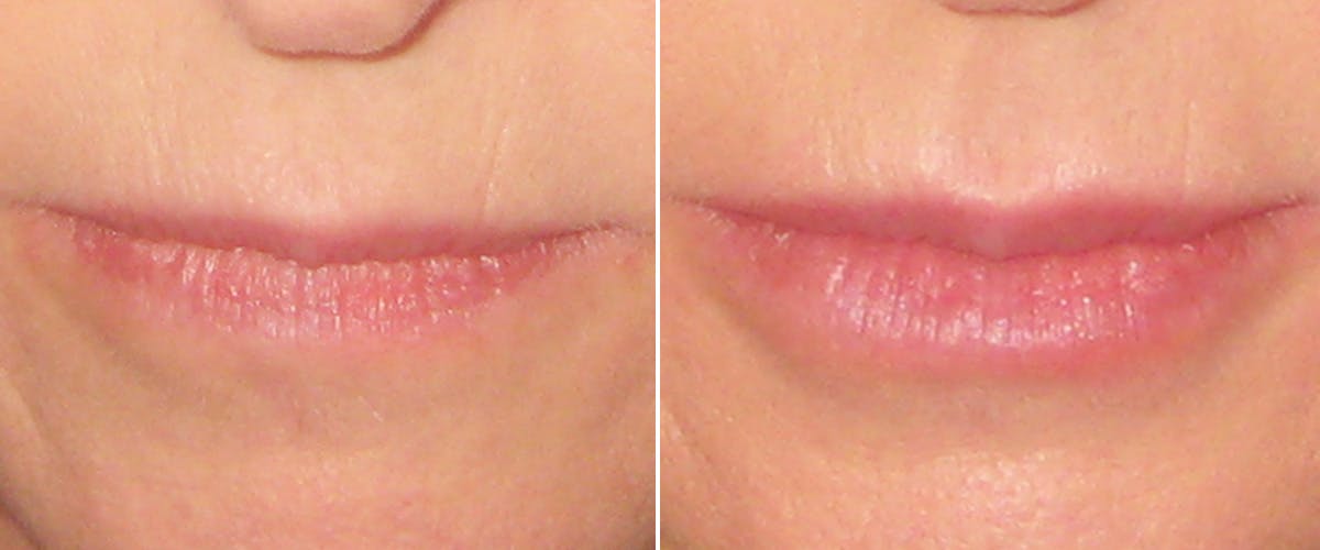 Facial Fillers Before & After Gallery - Patient 169273 - Image 1