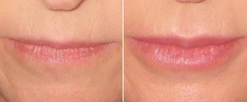 Facial Fillers Before & After Gallery - Patient 169273 - Image 1
