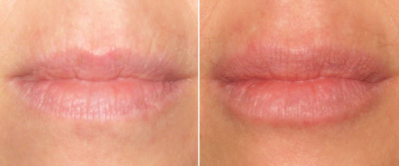 Facial Fillers Before & After Gallery - Patient 704039 - Image 1