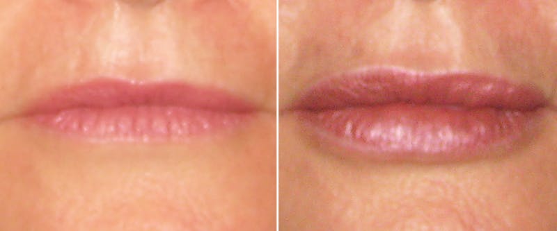 Facial Fillers Before & After Gallery - Patient 206087 - Image 1