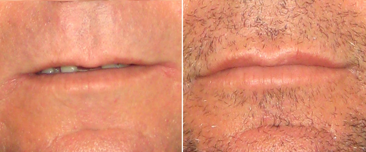 Facial Fillers Before & After Gallery - Patient 217738 - Image 1
