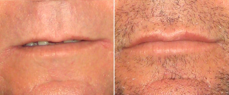Facial Fillers Before & After Gallery - Patient 217738 - Image 1