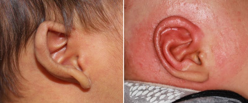 Earwell (Microtia) Before & After Gallery - Patient 908123 - Image 1