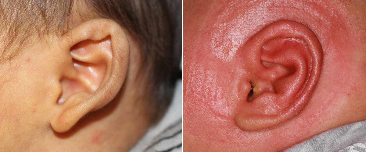 Earwell (Microtia) Before & After Gallery - Patient 908123 - Image 2