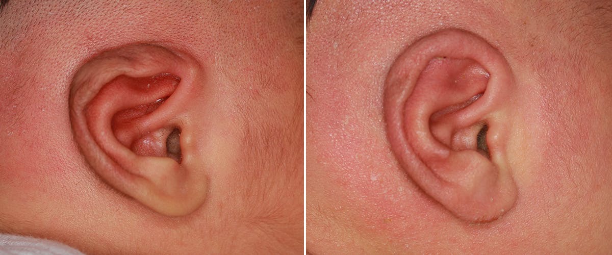 Earwell (Microtia) Before & After Gallery - Patient 186791 - Image 1