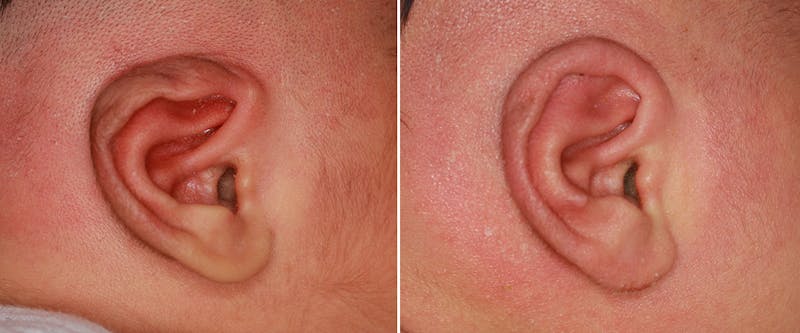Earwell (Microtia) Before & After Gallery - Patient 186791 - Image 1
