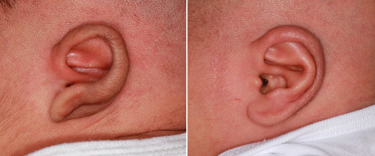 Earwell (Microtia) Before & After Gallery - Patient 186791 - Image 2