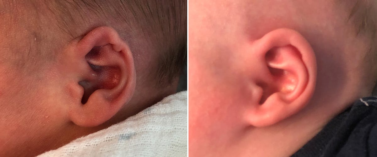 Earwell (Microtia) Before & After Gallery - Patient 388581 - Image 2