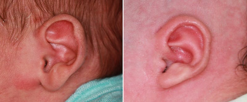 Earwell (Microtia) Before & After Gallery - Patient 357687 - Image 1