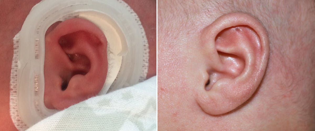 Earwell (Microtia) Before & After Gallery - Patient 228167 - Image 1