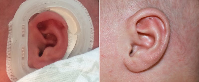 Earwell (Microtia) Before & After Gallery - Patient 228167 - Image 1