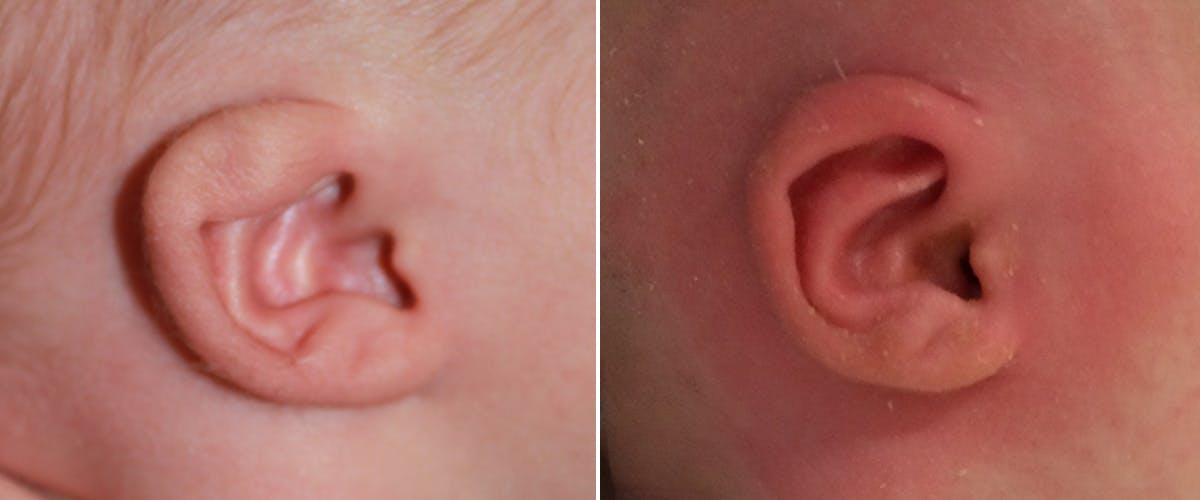 Earwell (Microtia) Before & After Gallery - Patient 300278 - Image 1