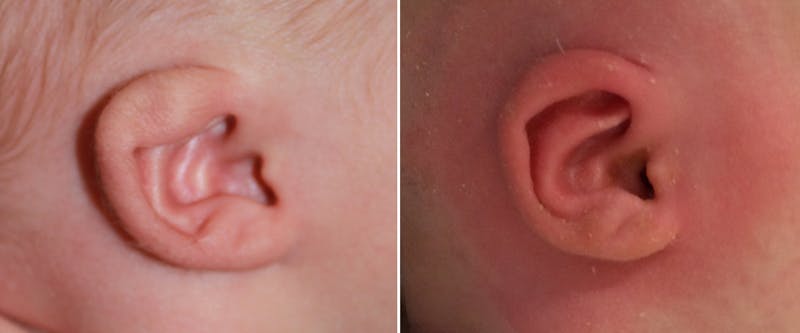 Earwell (Microtia) Before & After Gallery - Patient 300278 - Image 1