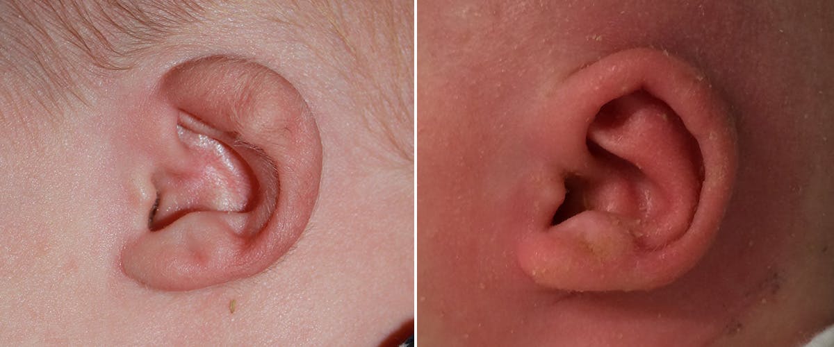 Earwell (Microtia) Before & After Gallery - Patient 300278 - Image 2