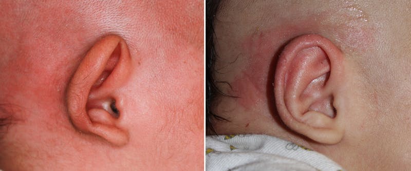 Earwell (Microtia) Before & After Gallery - Patient 429251 - Image 1